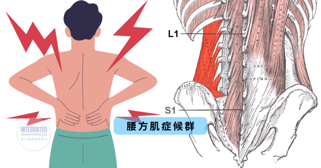 腰方肌症候群示意图，显示腰部疼痛位置及腰方肌的解剖位置关系。